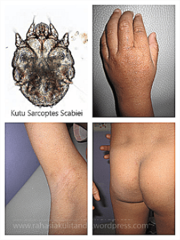 Skabies untuk blog