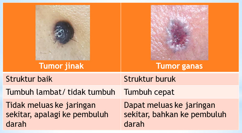 slide tumor 1