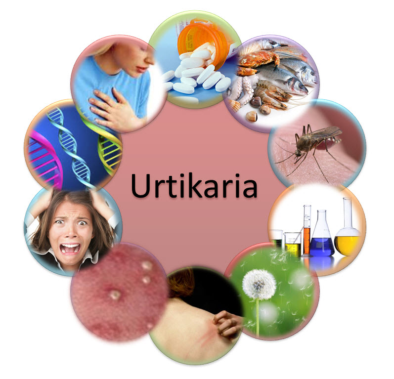 Urtikaria